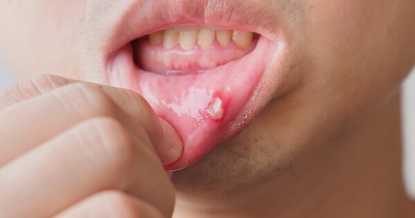 흡연과 음주를 함께 하면 구강암 발병 위험이 수십 배 높아진다. [출처: Gettyimagesbank]